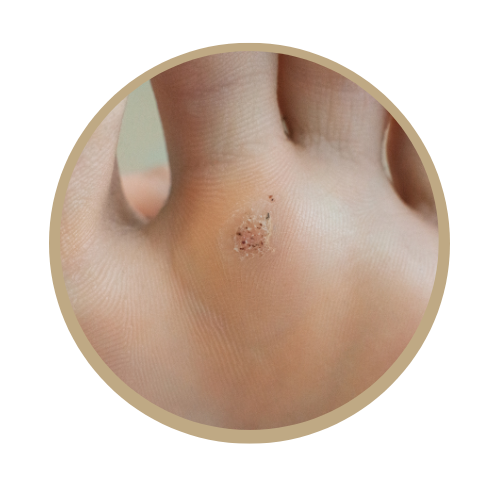 plantar wart black seeds Wart Treatment – Ancaster Foot Fixer and Orthotics Clinic