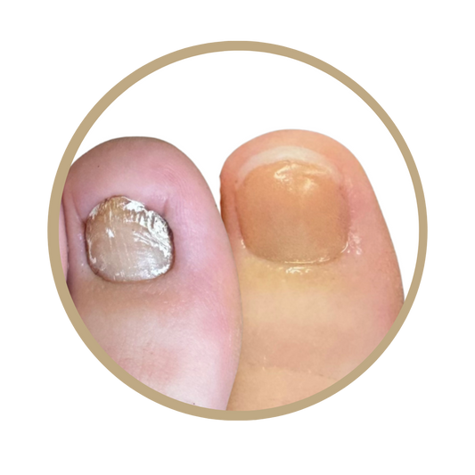 NEC - NAIL RECONSTRUCTION